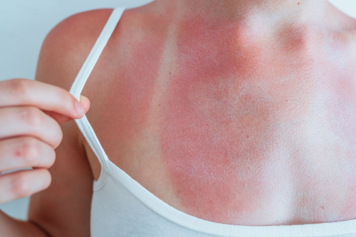 Sonnenbrand in Ostfriesland — Prävention, Sofortmaßnahmen un